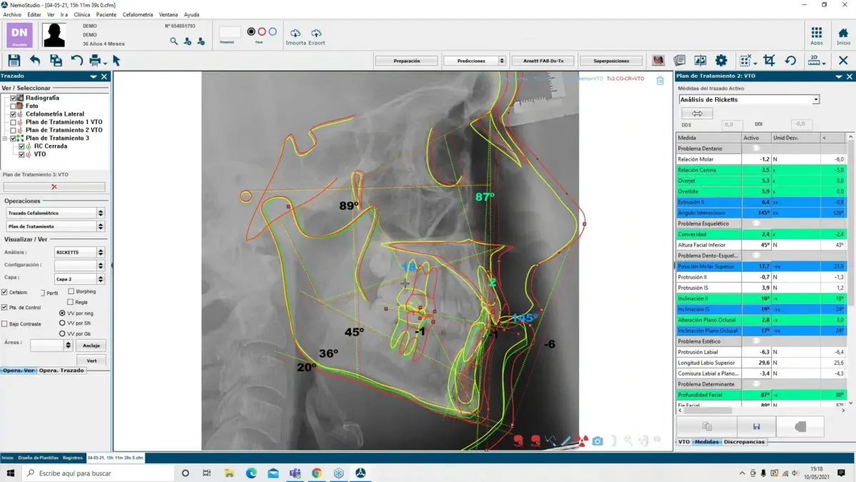 Licenta software NemoCeph pentru cefalometrie si VTO